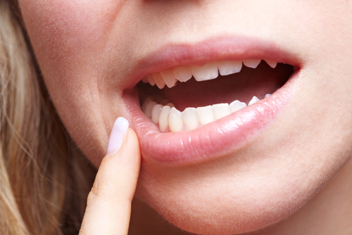 Connaissez-vous la différence entre la gingivite et parodontite?