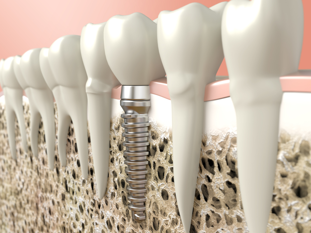 Implants dentaires - Les avantages des implants dentaires