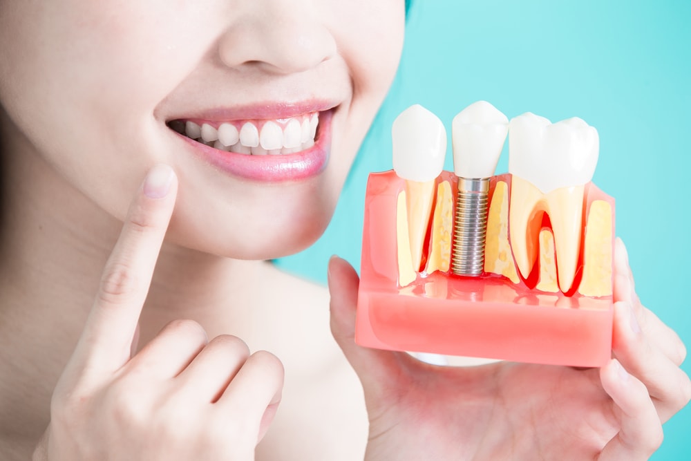 Les implants dentaires ont plusieurs avantages