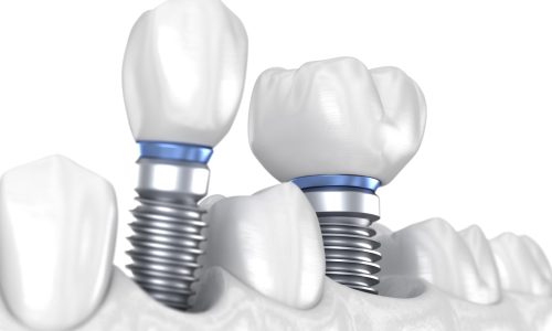Des implants dentaires remplacent deux dents manquantes