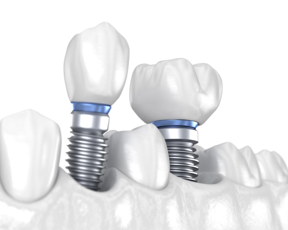 Des implants dentaires remplacent deux dents manquantes