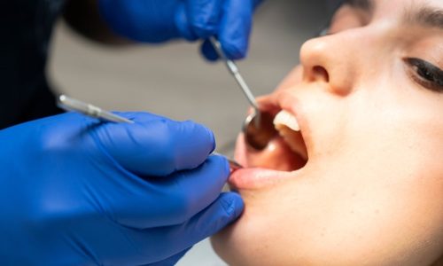 Un examen pour le dépistage du cancer de la bouche