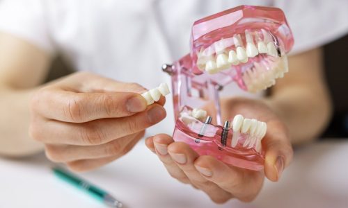 Un modèle en implantologie dentaire avec deux implants