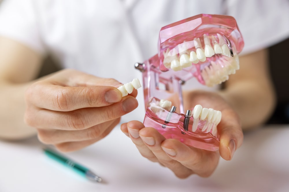 Un modèle en implantologie dentaire avec deux implants
