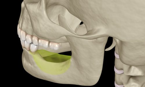 Une perte osseuse observée au niveau de dents manquantes