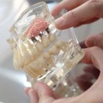 Un modèle avec implant dentaire inséré dans l'os de la mâchoire
