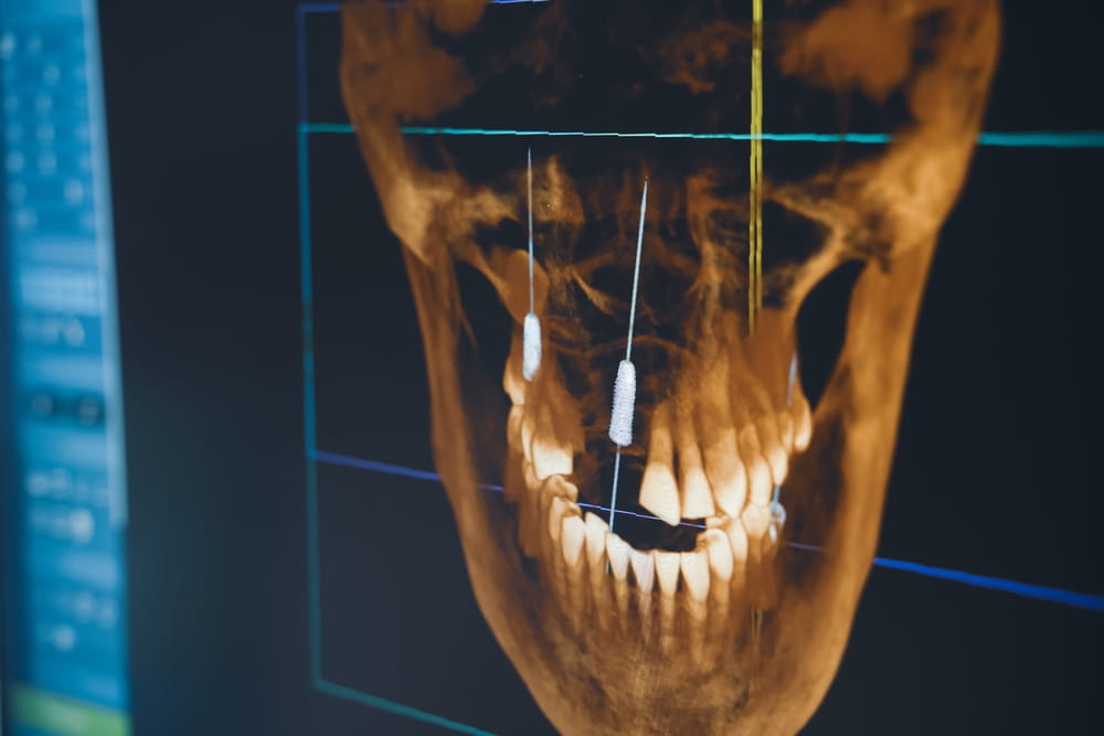 Image 3d d'une mâchoire avec implants dentaires sur le maxillaire supérieur